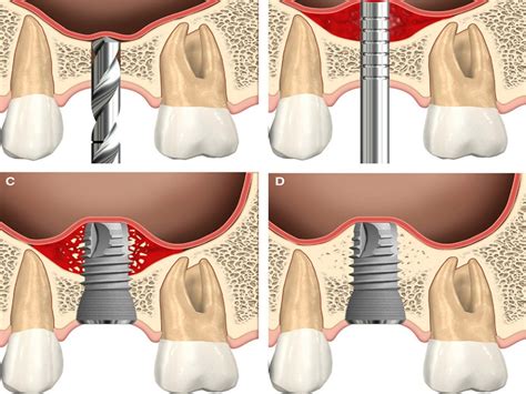 Yttrium Oxide Nanofibers:  Revolutionizing Bone Regeneration and Dental Implants?